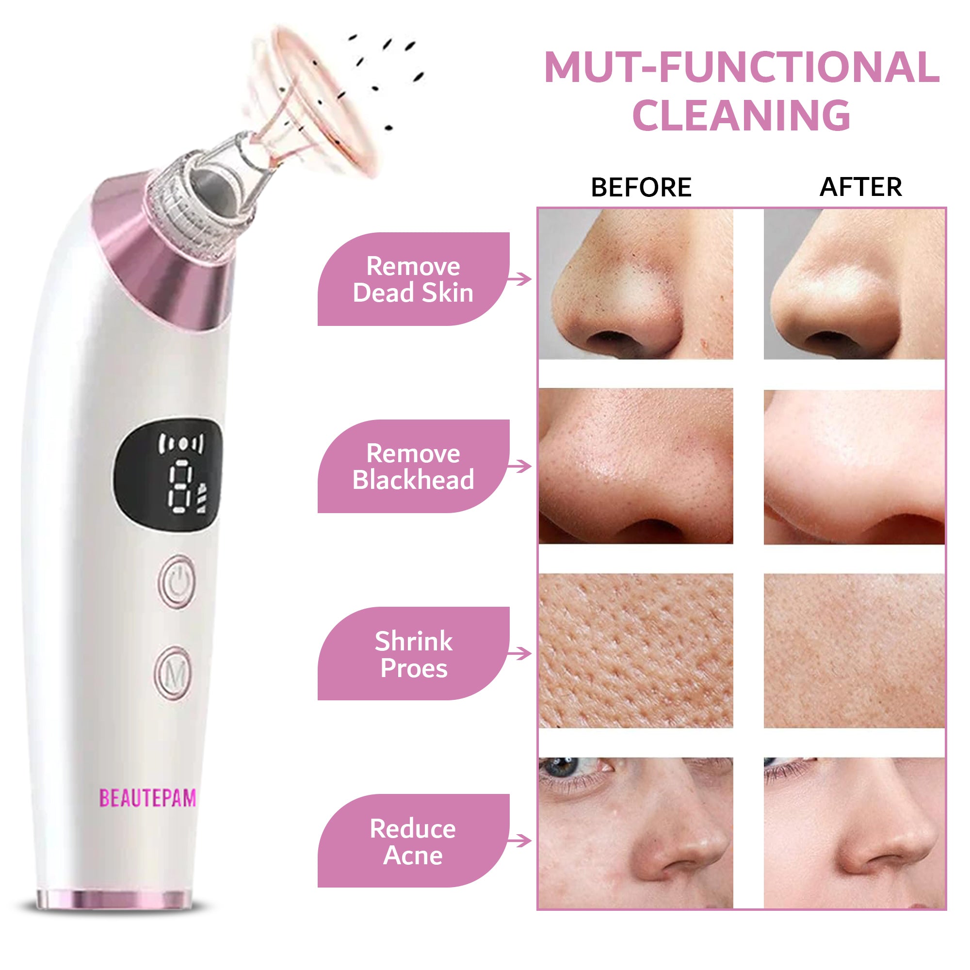 "Clear Pores, Radiant Skin: Beautepam-Enhanced Blackhead Vacuum